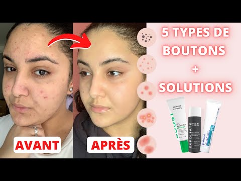 Vidéo: 6 Choses à Savoir Sur Les DIU Et L'acné: Déclencheurs, Traitement Et Plus