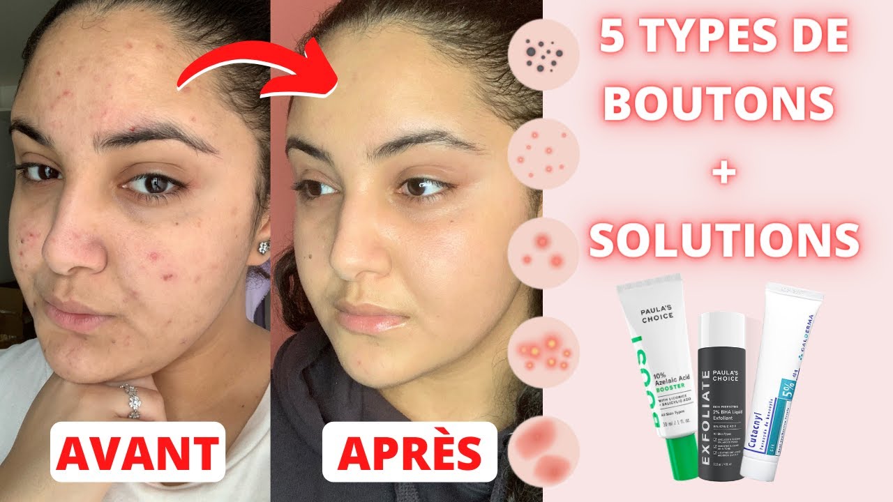 L'ACNÉ : MA ROUTINE SKINCARE + TOUTES LES SOLUTIONS POUR CHAQUE TYPE DE  BOUTON !