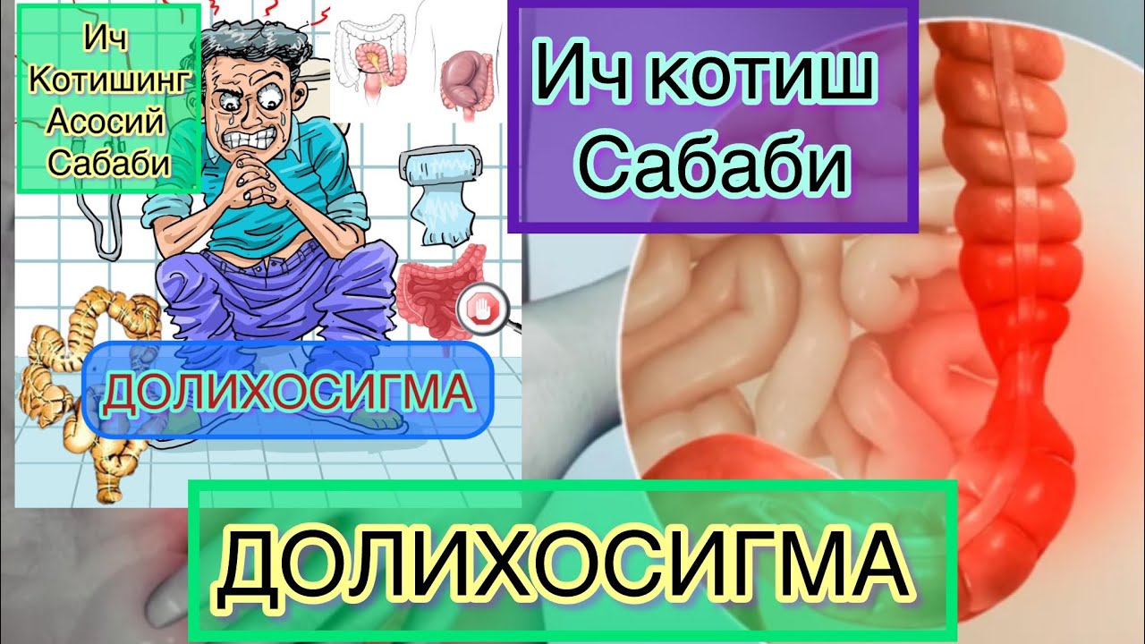 Ич котиш сабаби- Долихосигма. Ичакнинг узунлашиб кетиши.  Телеграм : https://t.me/+0jtKJSMBV2RmMzIy