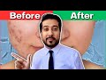 How to Get Rid of EVERY Type of Acne Scar | The Acne Scar ULTIMATE GUIDE