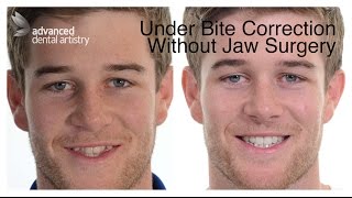 UnderBite Non Surgical Cosmetic Treatment  Shaun's Transformation