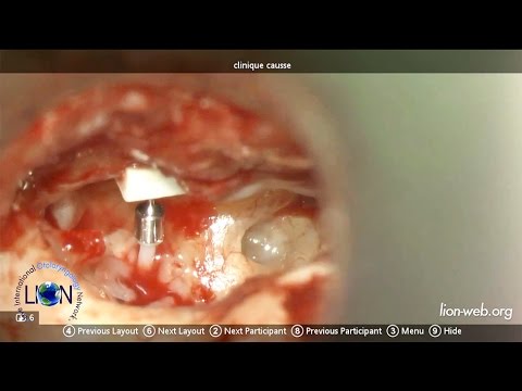 Live Surgery Otosclerosis Revision Operation Incus Erosion (Robert Vincent)