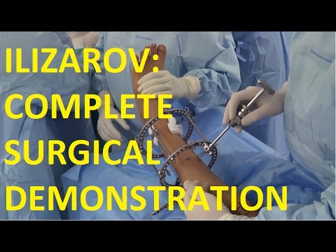 Sri Sathya Sai International Ilizarov Conference - Live Surgery Demonstration