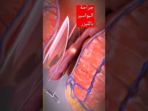 جراحة البواسير بالليزر   