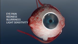 Eye redness, pain and blurred vision 🧐. UVEITIS {Eye inflammation}. #eye #uveitis