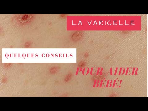 Vidéo: Bain à L'avoine Pour La Varicelle