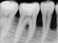 Dental Bone Loss - Bone Grafting in Denville, NJ