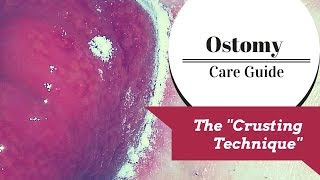 The Ostomy Crusting Technique Explained!