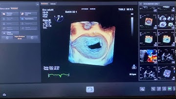 EVALUATION OF MITRAL VALVE AT TRANSESOPHAGEAL ECHOCARDIOGRAPHY (TEE)