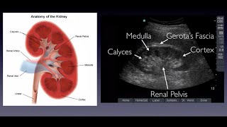 Introduction to Renal Ultrasound screenshot 3