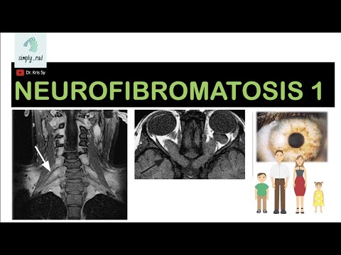 Video: Perubahan Craniofacial Dan Lisan Pada Pesakit Dengan Neurofibromatosis 1