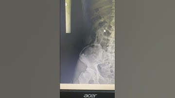 Suy thận do sỏi niệu quản #Soithan #noisoiongmem #bacsitung #pcnl #aroretic #akicare #tansoithan