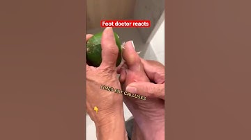 Doctor reacts: foot callus lifehack