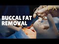 Buccal Fat Removal Basics: Cost, Technique, Facts and Myths