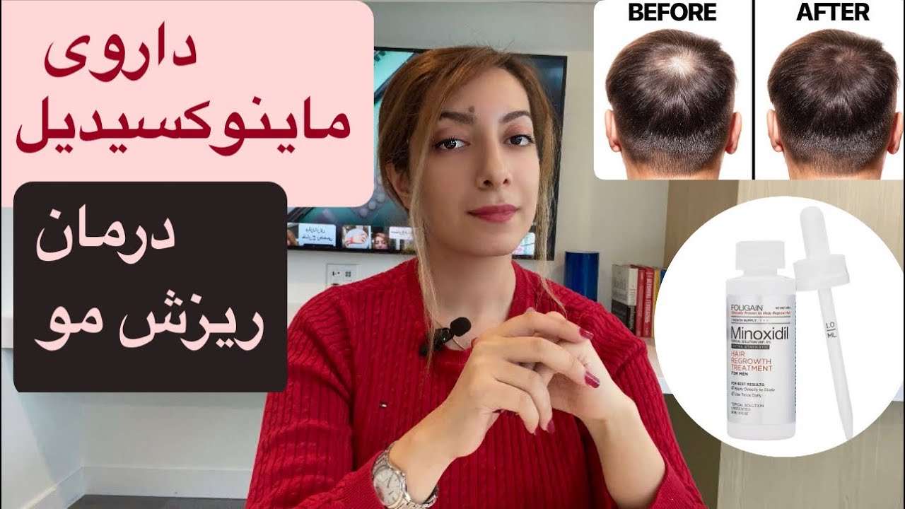 داروی ماینوکسیدیل( درمان ریزش مو )/Minoxidil