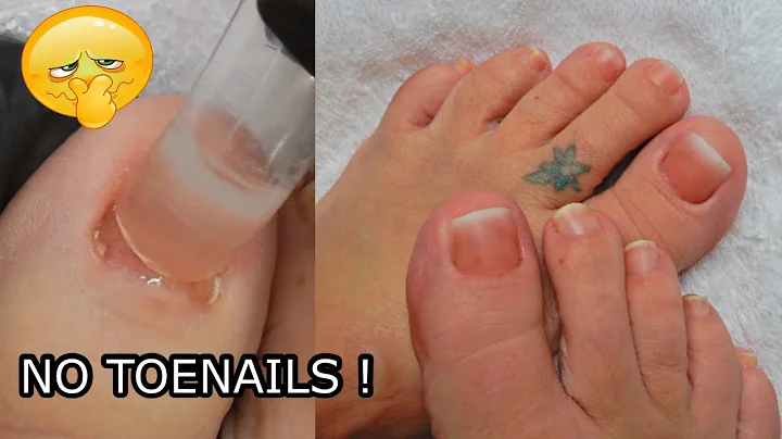 I have NO Toenails My  ATTEMPT With Dual Forms To ...