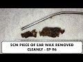 2CM PIECE OF EAR WAX REMOVED CLEANLY - EP 96