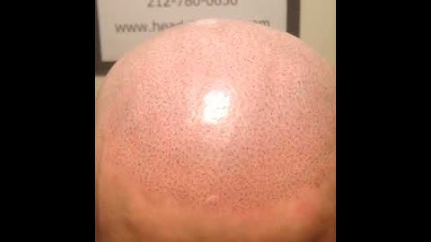 3d Scalp Micropigmentation talk with Chris & client on Art honesty etc