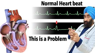 Understand Premature Heart Contraction | Ectopic Beat | PVC | VPC | Dr.Education