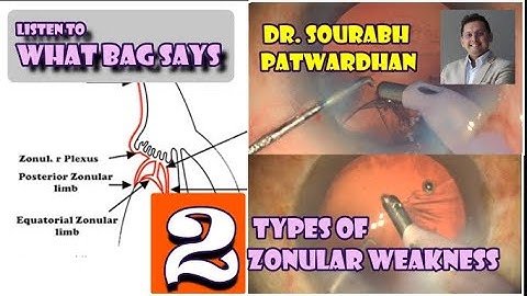 80 two types of zonular weakness- Dr Sourabh Patwardhan : Cortex peel technique with weak zonules
