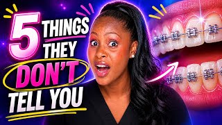5 things they don’t tell you before getting braces on