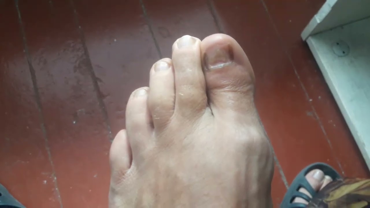 лечение грибка ногтей 3