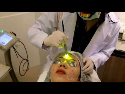 🚩ยิงเลเซอร์ลดรอยสิว หรือจะทำหน้าขาวใส Dual Yellow Laser ก็จัดให้ได้จ้า Amarante Clinic