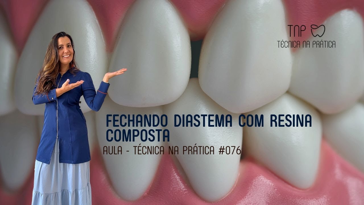 Fechamento de Diastema com Resina Composta - TNP(#076) - YouTube