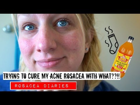 A Natural Treatment For Acne Rosacea??! | Rosacea Diaries | Trying Apple Cider Vinegar Part 