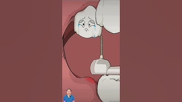 Bật mí sao nhổ răng khôn hàm dưới mà cần nhổ răng hàm trên! #rangkhon