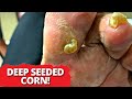 DEEP SEEDED Corn Removal On Big Toe!