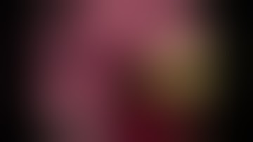 Left Motor Area Glioma (Central Dysembryoplastic Neuroepithelial Tumor)