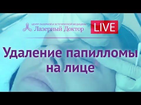 Лазерное удаление папиллом на веках - Periscope