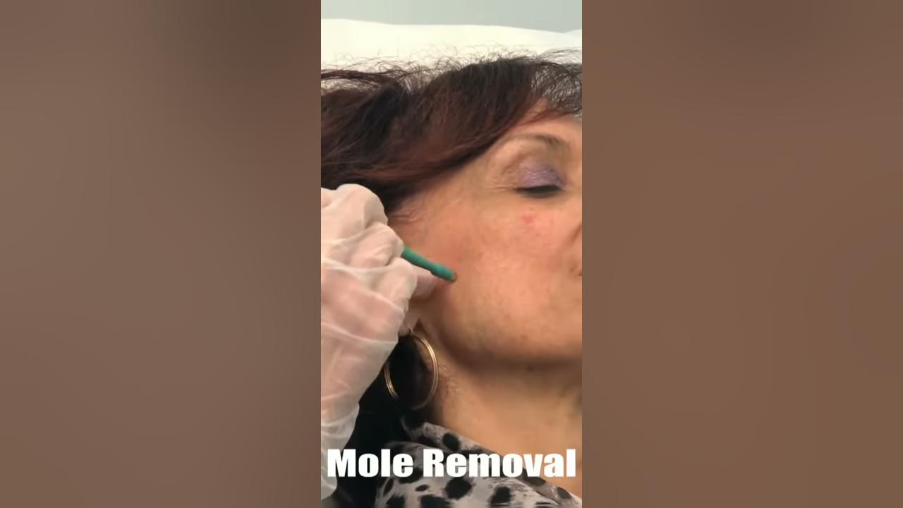 Punch Mole Removal By Dr. Bailey YouTube