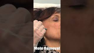 Punch Mole Removal By Dr. Bailey