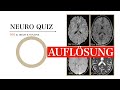 Neuro Quiz 001 I Auflösung I Multiple Sklerose I Neuroradiologie I Gehirn I  Brain & Synapse