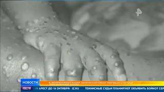 В Британии обнаружили оспу обезьян