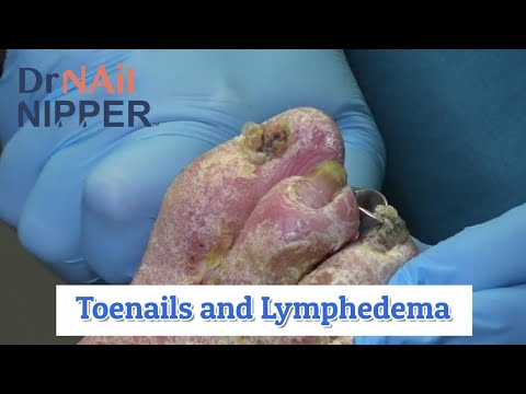 Big Chunks. What is Lymphedema?  Dr Nail Nipper Explains on Extended Video (2020)