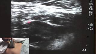 Ultrasound Guided Fascia Illiaca - SSRAUSA.com