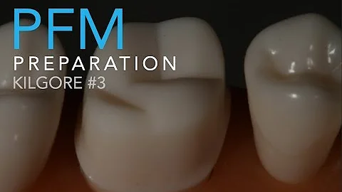 Molar Ceramo-Metal Preparation | How to Prepare a ...