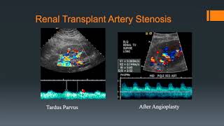 Renal Transplants