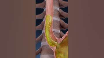 Acid Reflux, GERD, and Heartburn explained in 3D