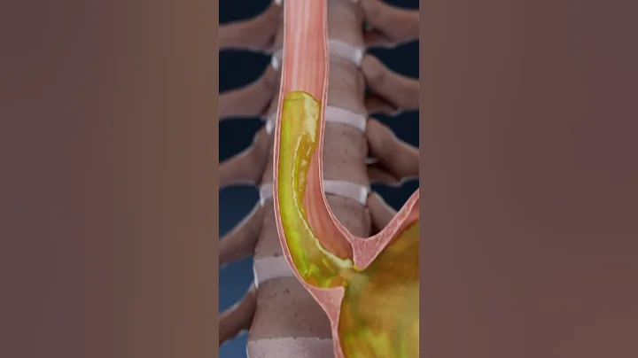 Acid Reflux, GERD, and Heartburn explained in 3D