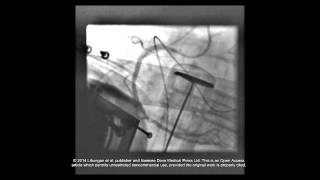 Case report: PCI during cardiac arrest - Supplementary video 2 [57953] Pci During Cardiac Arrest Using The Lucas Device