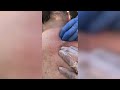 Popping huge blackheads and giant pimples  best pimple poppings 127