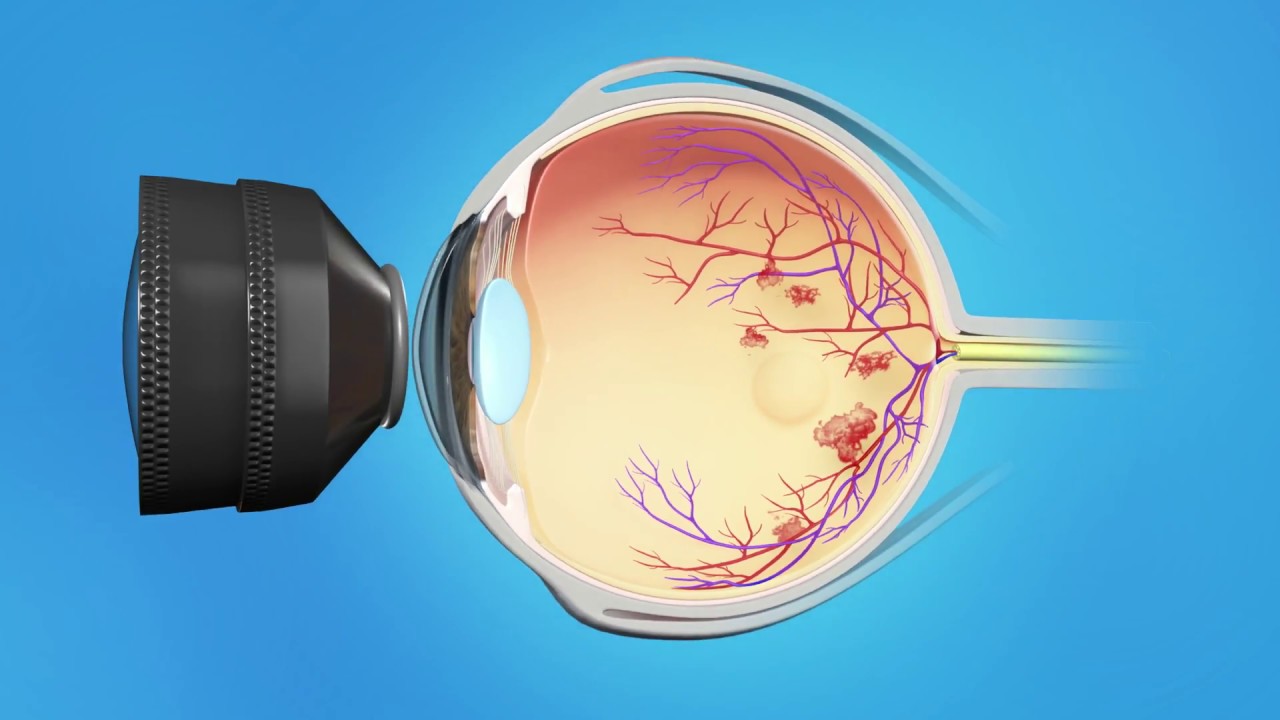 Retina Diabetic Laser Macular Edema YouTube