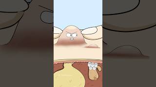 Why Your Pimple Comes Back Bigger After Popping?