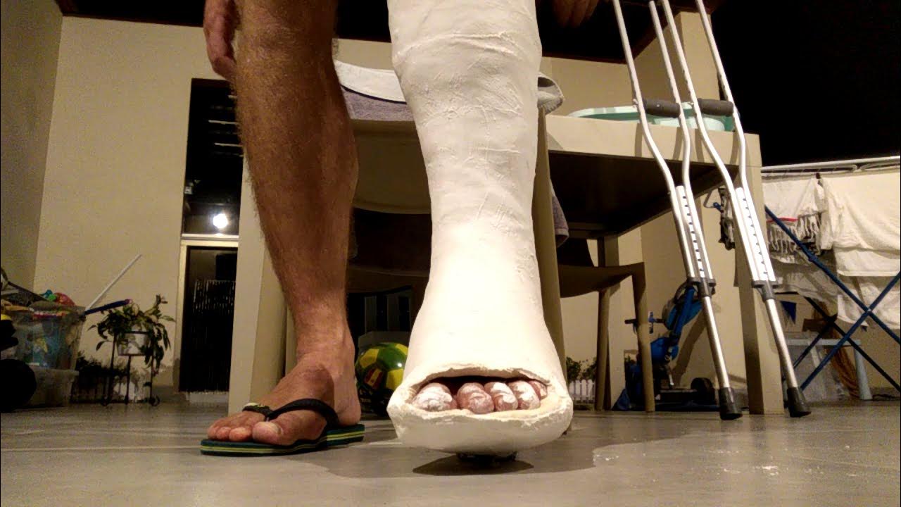 short leg walking plaster cast YouTube