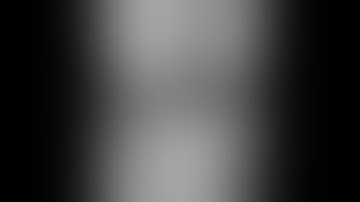 Robotic Assisted Uretero-ureterostomy For Retrocaval Ureter