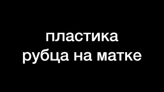 пластика рубца на матке после кесарева сечения